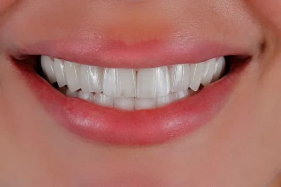 Smile makeover result 1 at Dent KM dental clinic