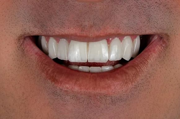 Smile makeover result 3 at Dent KM dental clinic