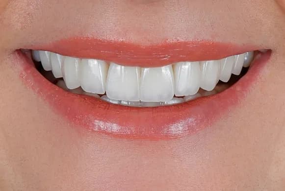 Smile makeover result 4 at Dent KM dental clinic